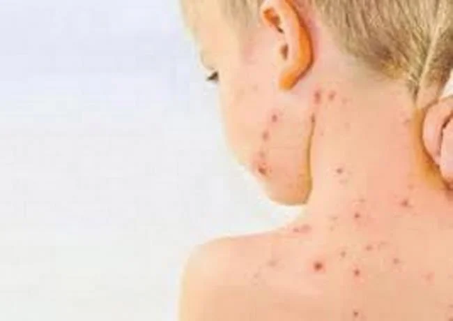 OMS alerta de brotes de sarampi&oacute;n en el mundo tras disminuci&oacute;n de tasa de vacunaci&oacute;n