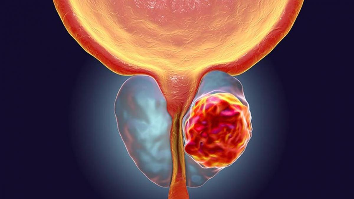 D&iacute;a Mundial del C&aacute;ncer de Pr&oacute;stata; segundo m&aacute;s com&uacute;n en hombres