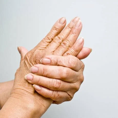 Dolor y rigidez articular son se&ntilde;ales de un caso de artritis