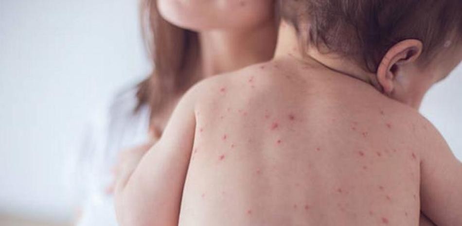 Salud Pública dispone alerta epidemiológica para sarampión