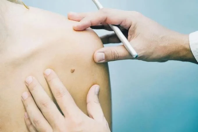 Se incrementa el c&aacute;ncer de piel entre los dominicanos