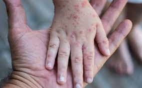 Baja vacunaci&oacute;n aumentar&iacute;a brote de sarampi&oacute;n en el mundo, alerta OMS