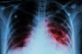 Los s&iacute;ntomas de la tuberculosis son la tos, fiebre y debilidad