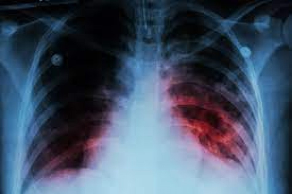 Los síntomas de la tuberculosis son la tos, fiebre y debilidad