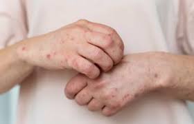 Instituto Dermatol&oacute;gico recomienda a la poblaci&oacute;n no automedicarse para tratar la varicela