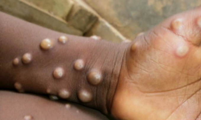 Los estigmas psicol&oacute;gicos que deja la viruela del mono