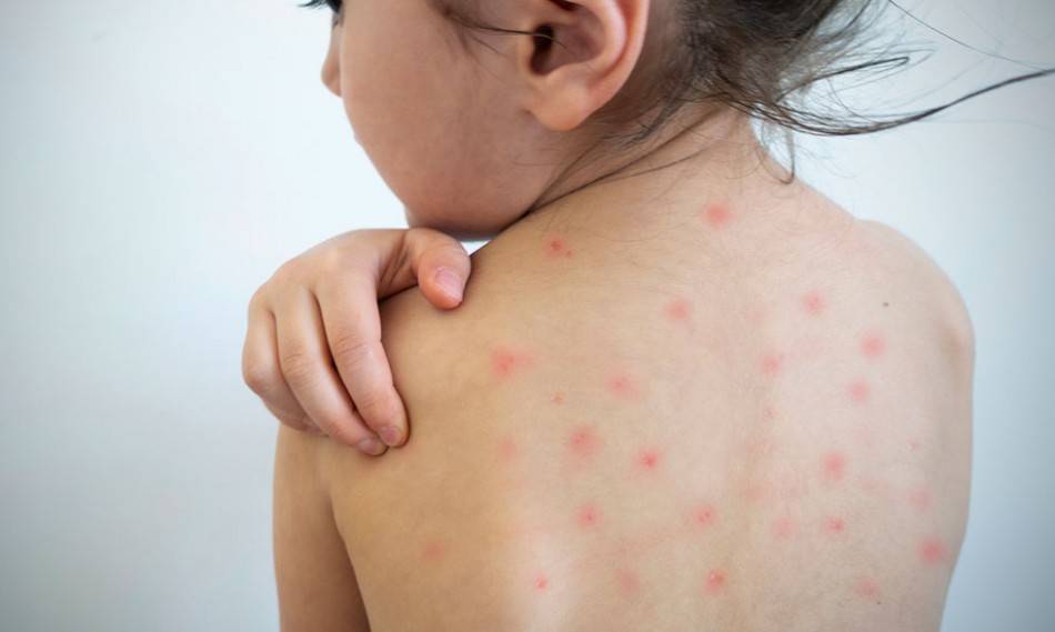 PAI llama a la poblaci&oacute;n vacunarse contra el sarampi&oacute;n y otras enfermedades