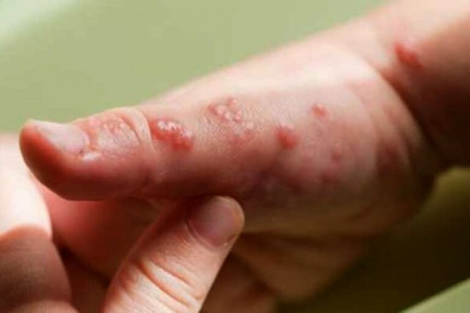 El virus de la viruela del mono podr&iacute;a transmitirse tambi&eacute;n por v&iacute;a a&eacute;rea