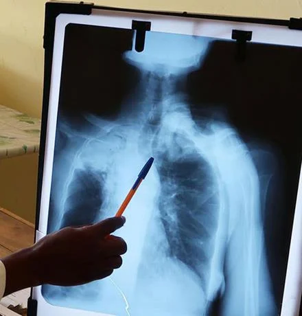 Se registra 4 mil casos de tuberculosis