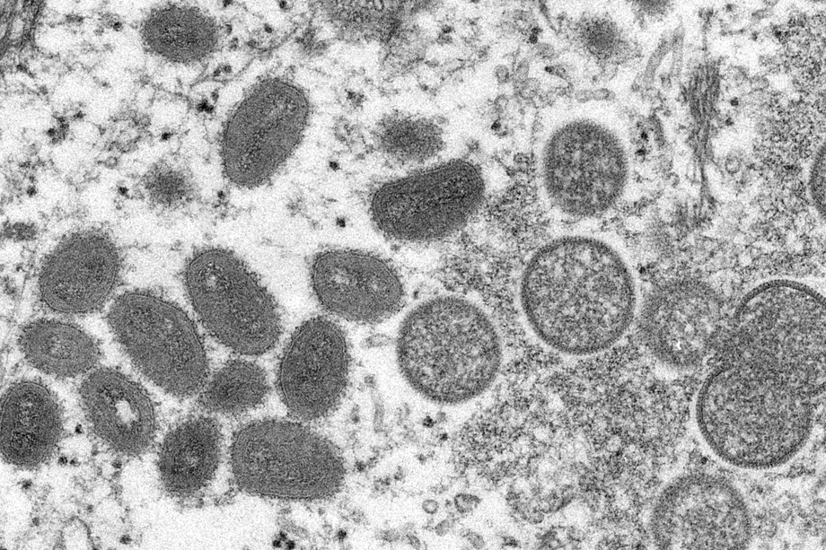 Viruela del mono: qu&eacute; es, c&oacute;mo se contagia, cu&aacute;les son sus s&iacute;ntomas