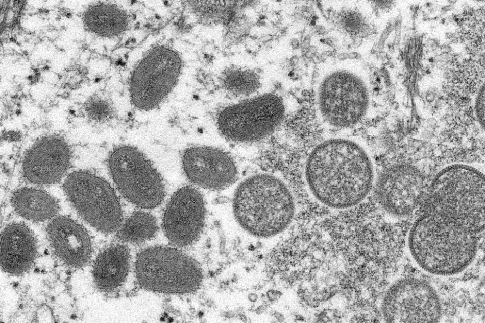 Viruela del mono: qu&eacute; es, c&oacute;mo se contagia, cu&aacute;les son sus s&iacute;ntomas