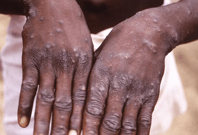 Un paciente haitiano en Ocoa es el d&eacute;cimo caso de viruela s&iacute;mica en RD