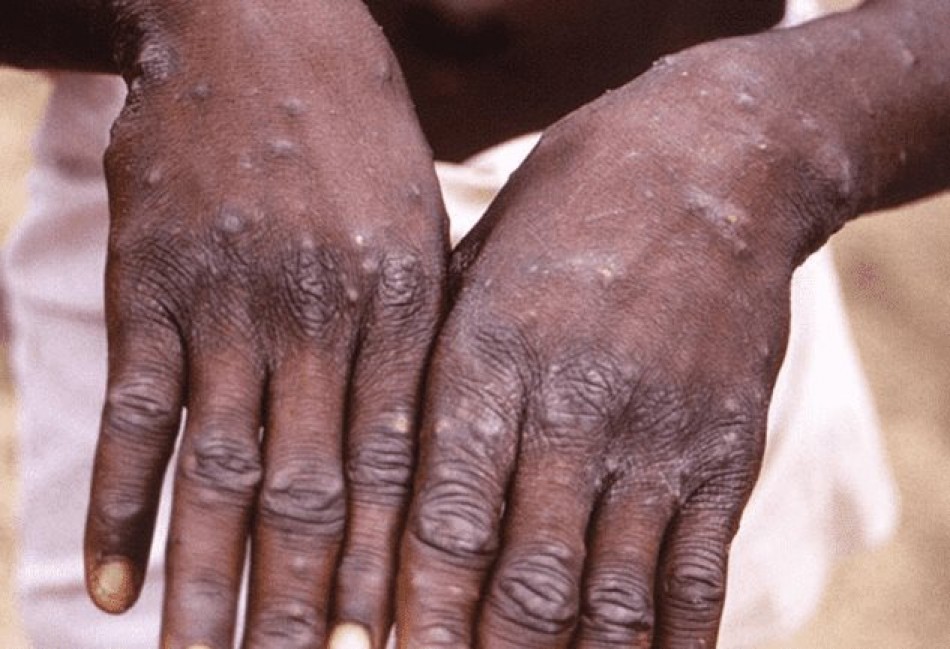 Un paciente haitiano en Ocoa es el d&eacute;cimo caso de viruela s&iacute;mica en RD