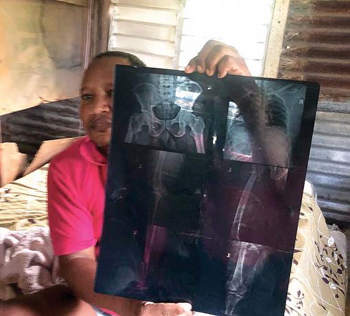 "Yo quiero que me operen y restaurar mi salud", clama hombre que tiene 5 meses con tres fracturas en una pierna